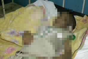 'Jilted' Lover Throws Acid On Female In Patiala